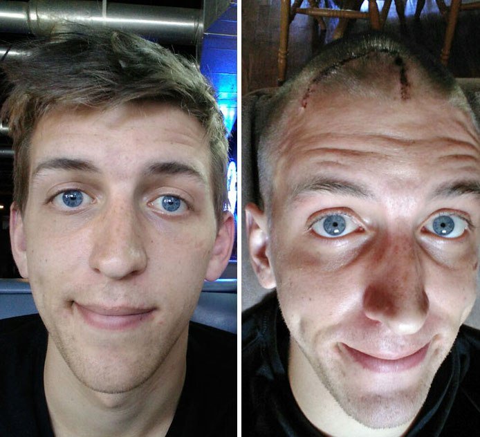NTD Before After Pics Of People Who Beat Cancer11 - 