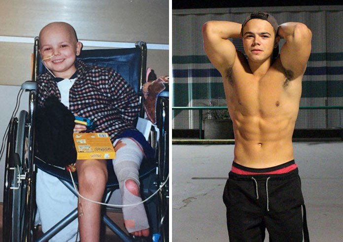 NTD Before After Pics Of People Who Beat Cancer32 - 