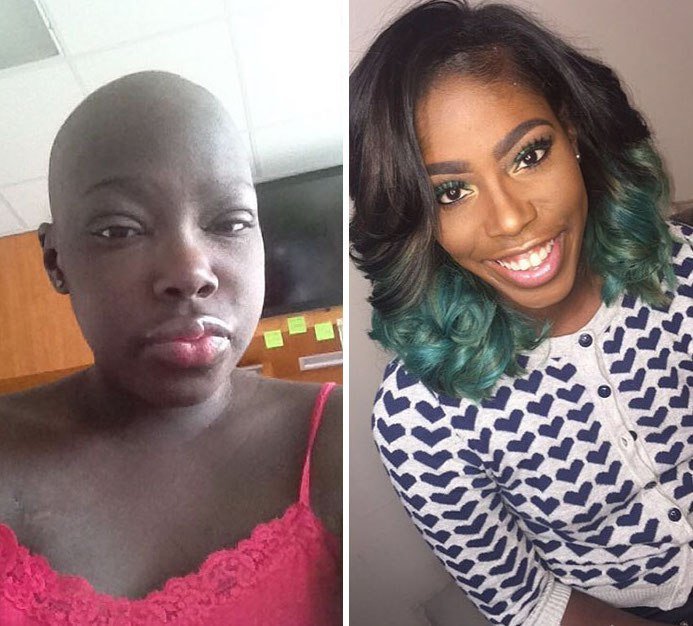 NTD Before After Pics Of People Who Beat Cancer5 - 