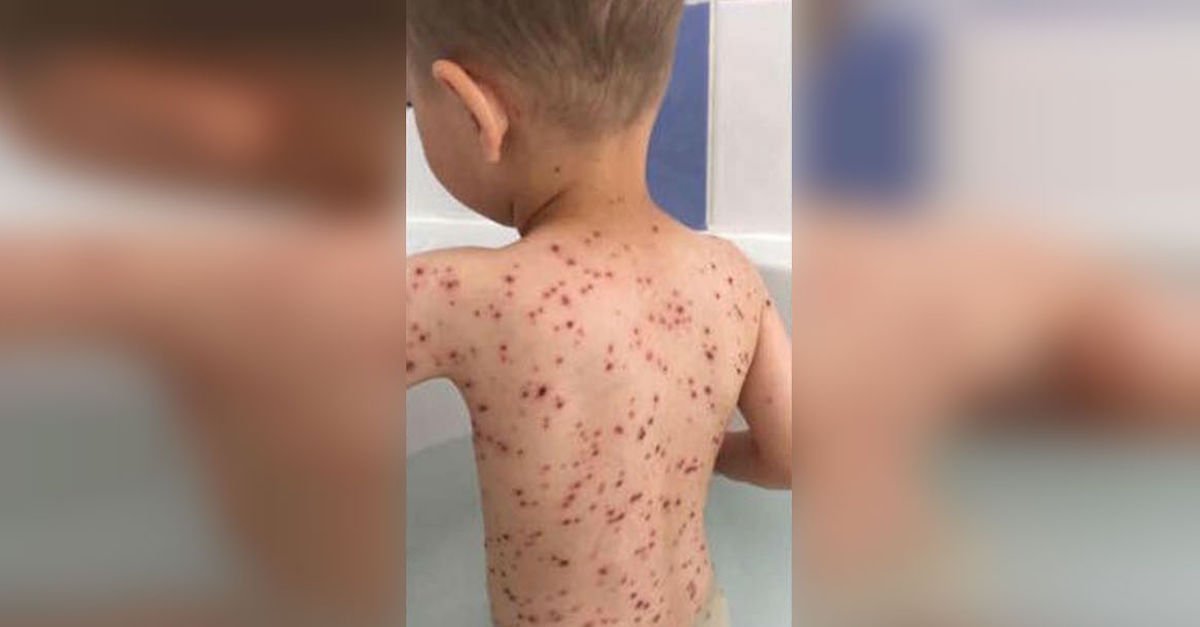 chickenpox.jpg?resize=412,275 - Young Boy Cried Out In Pain, That's When Mother Realized Doctors Made BIG Mistake