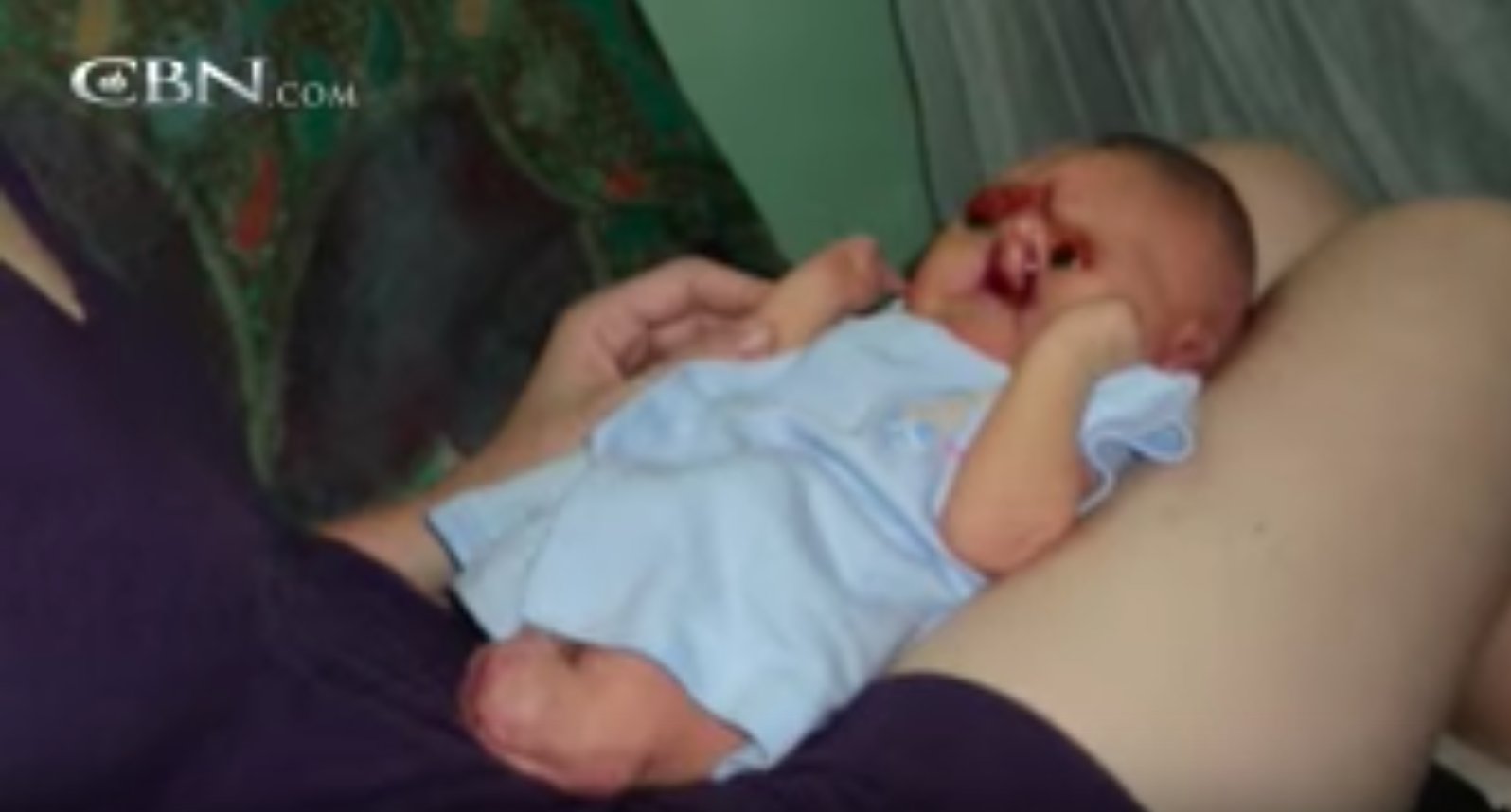 Mom abandons her own baby after seeing his face, so the nurse does the UNTHINKABLE... Baby Adam2 - Mom abandons her own baby after seeing his face, so the nurse does the UNTHINKABLE...