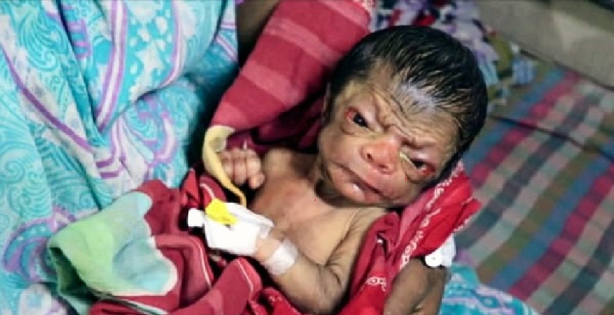 benjamin button baby feature 1 e1485328502120.png?resize=1200,630 - Doctors Are SHOCKED When They See This Newborn Baby That Looks Like An 80-Year-Old Man!