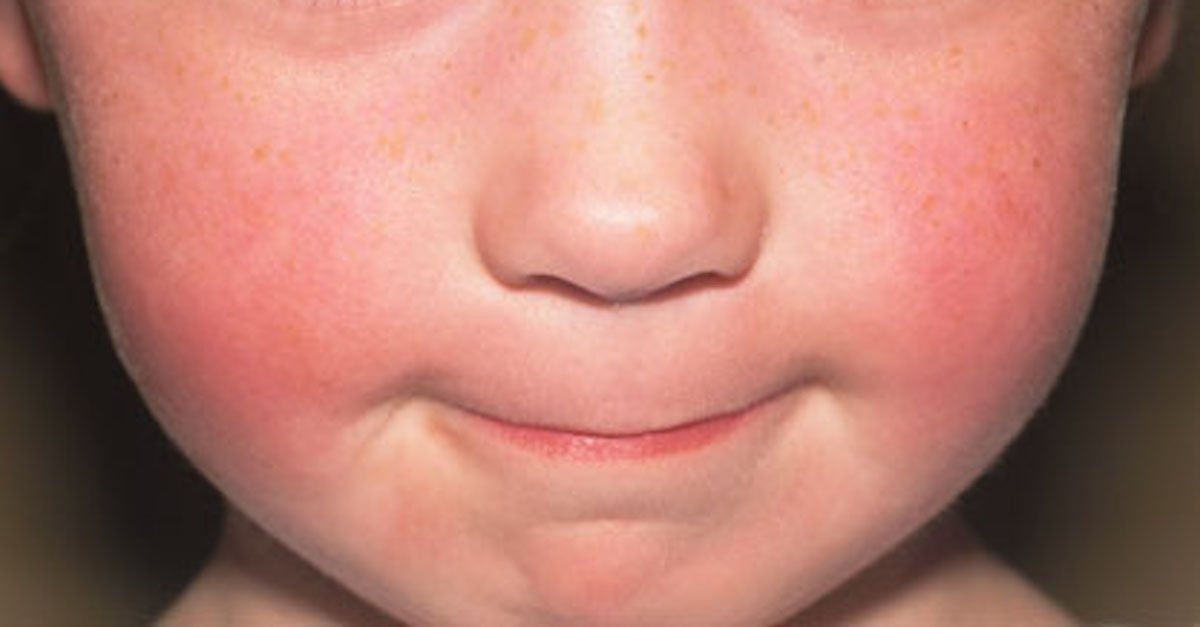 phototake child cheeks fifth disease.jpg?resize=1200,630 - As Tooth Decay In Children Reaches All Time High Doctors Warn Parents Of These Dangerous Foods