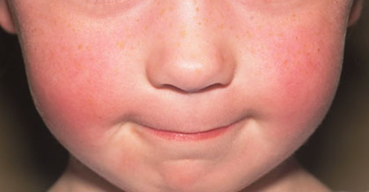 phototake child cheeks fifth disease.jpg?resize=412,275 - Doctors Warned Parents Of Dangerous Foods As Tooth Decay In Children Reached All-Time High