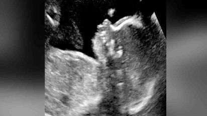 baby born with hair 412x232.jpg?resize=412,232 - Ultrasound Revealed Baby Had Unusual Amount Of Hair On His Head While Still In The Womb
