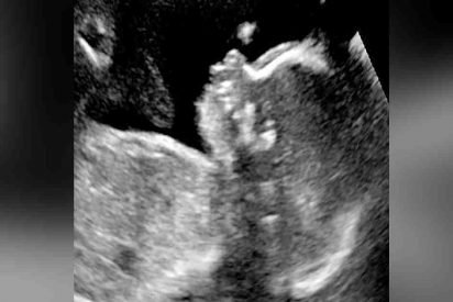 baby born with hair 412x275.jpg?resize=412,275 - A Couple Goes For Their Ultrasound But When The Doctor Sees Their Baby Even He's Surprised!