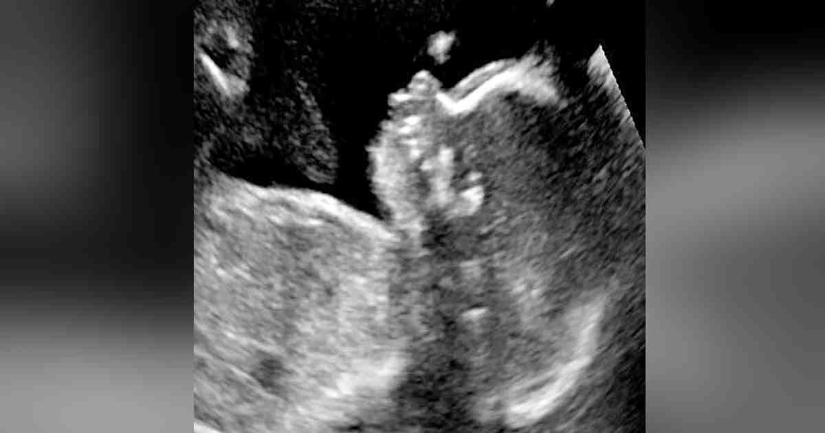 baby born with hair.jpg?resize=1200,630 - Ultrasound Revealed Baby Had Unusual Amount Of Hair On His Head While Still In The Womb