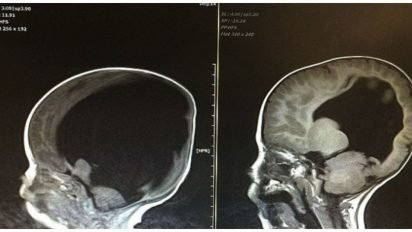 baby with no brain cover 412x232.jpg?resize=412,232 - Baby Born With Almost No Brain Is Thriving After His Brain Started Growing Following His Birth