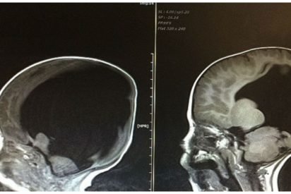 baby with no brain cover 412x275.jpg?resize=412,275 - He's Born With No Brain.. But 3 Years Later, Doctors In Shock When They See His Scans