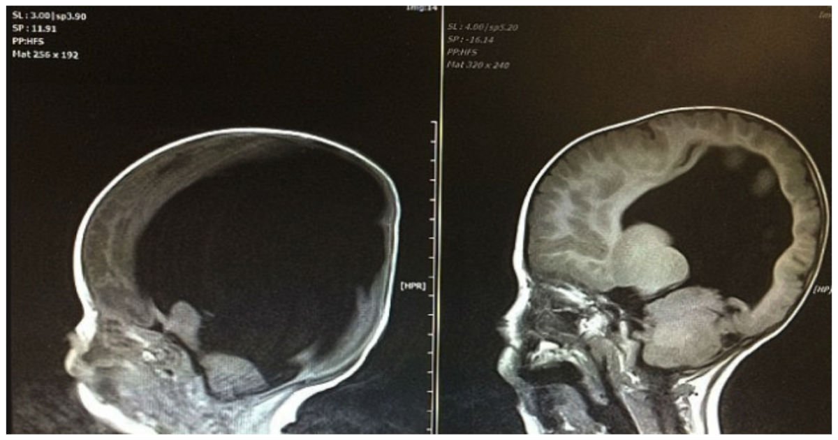 baby with no brain cover.jpg?fit=1024%2C538&ssl=1&strip=all - He's Born With No Brain.. But 3 Years Later, Doctors In Shock When They See His Scans
