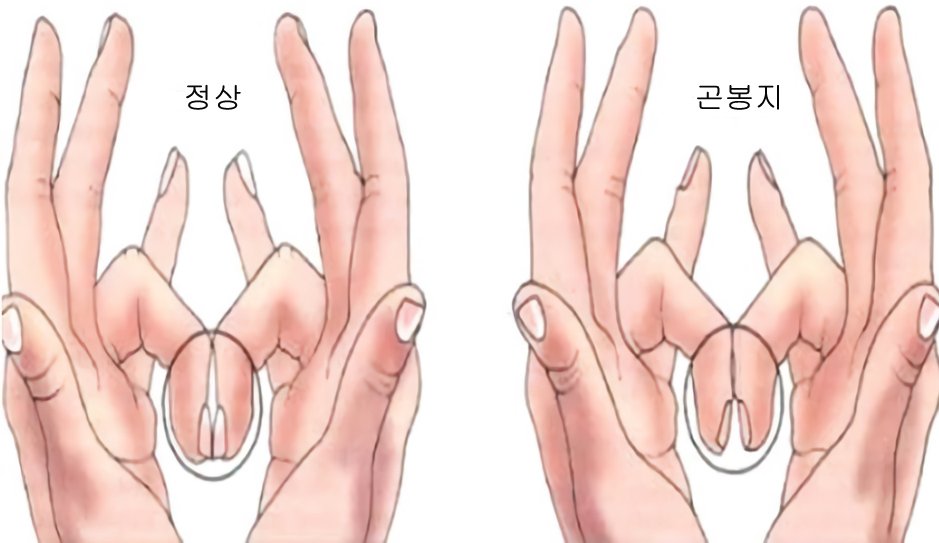 손톱이 '굽은 모양'을 하고 있다면 ‘이 질환’을 의심해 봐야… 1708260303 1 - 손톱이 '굽은 모양'을 하고 있다면 ‘이 질환’을 의심해 봐야…
