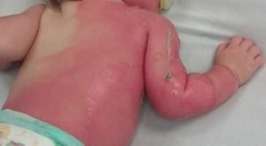 phoenix-bébé-brûlé