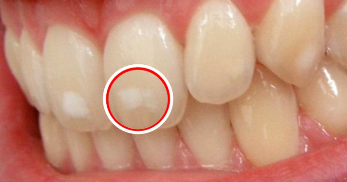 img 59a85d9cf25e3.png?resize=412,275 - なんとなく目障りの歯にできる白い斑点、なぜできるのか？