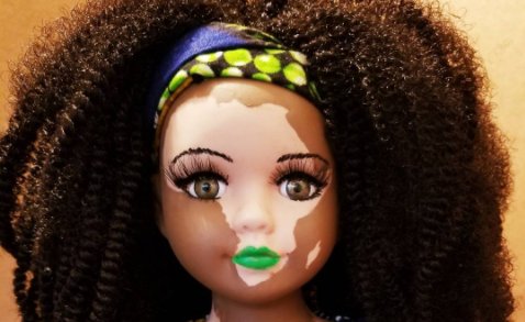 thumbnail 2.png?resize=412,275 - Artista cria bonecas com vitiligo para pessoas com essa rara condição de pele