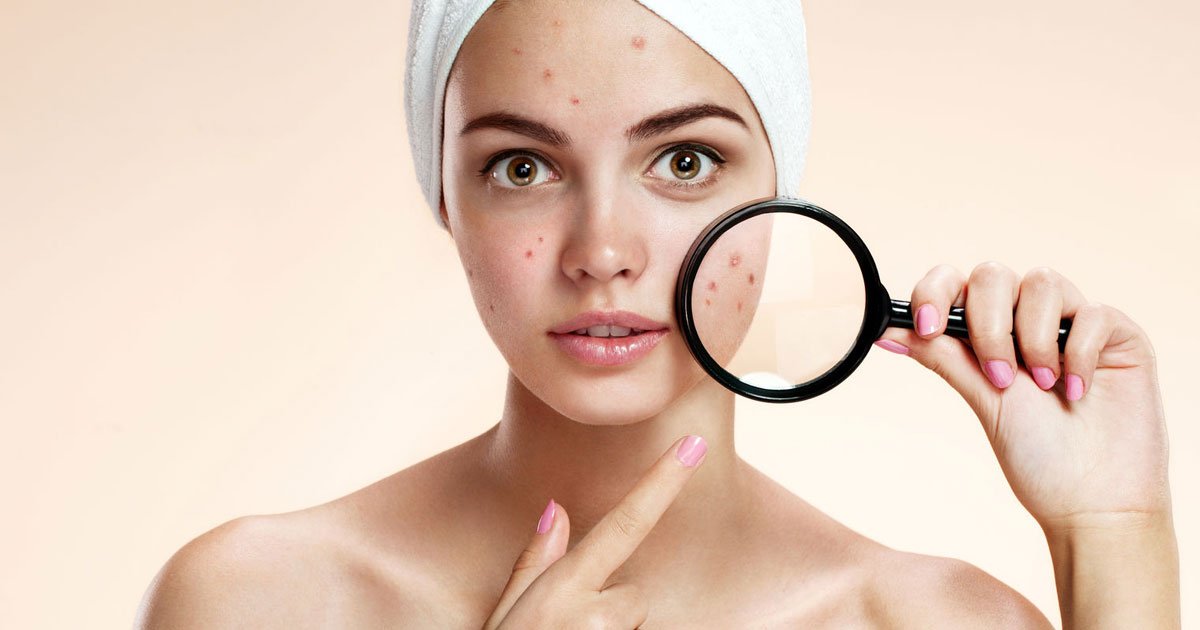 acne.jpg?resize=412,275 - El acné en tu rostro indica qué órgano de tu cuerpo necesita cuidado.