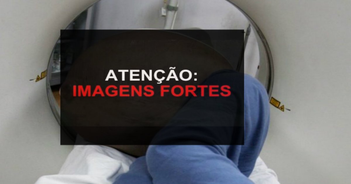 atencao.jpg?resize=412,275 - Constipado desde o nascimento, jovem de 22 anos tem 14 kg de fezes removidas do seu intestino