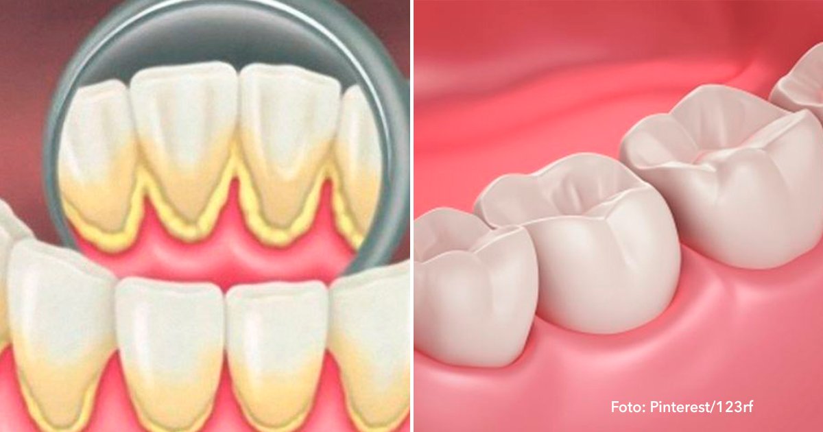 Podrás Prevenir La Placa Dental Y El Sarro Con Estos 2 Sencillos ...