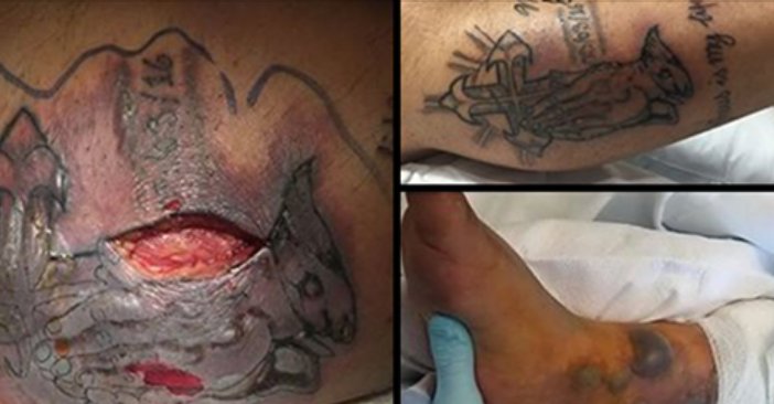 ecbaa1ecb298 52.png?resize=412,232 - A Man Went Swimming With His New Tattoo... Hours Later He Got Septic Shock