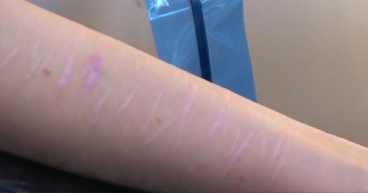 tattoo artist stands up for covering self harm scars of 19 year old