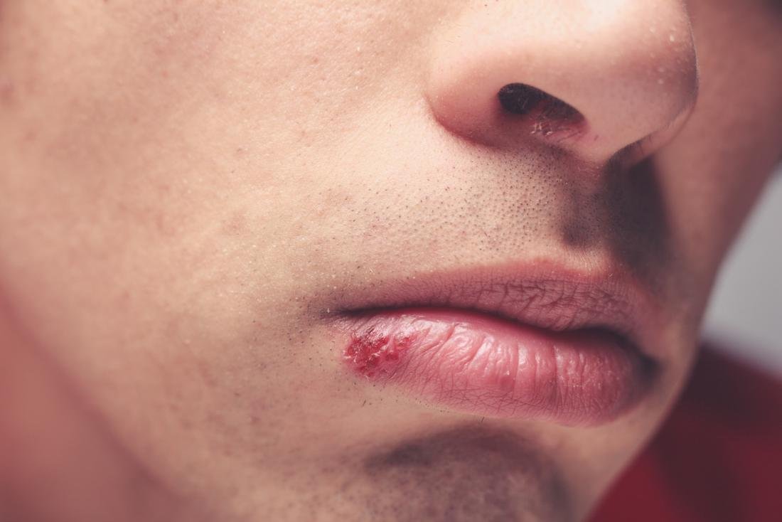 Everything About Cold Sores What Are They What Causes Them And How    Man With Cold Sore 