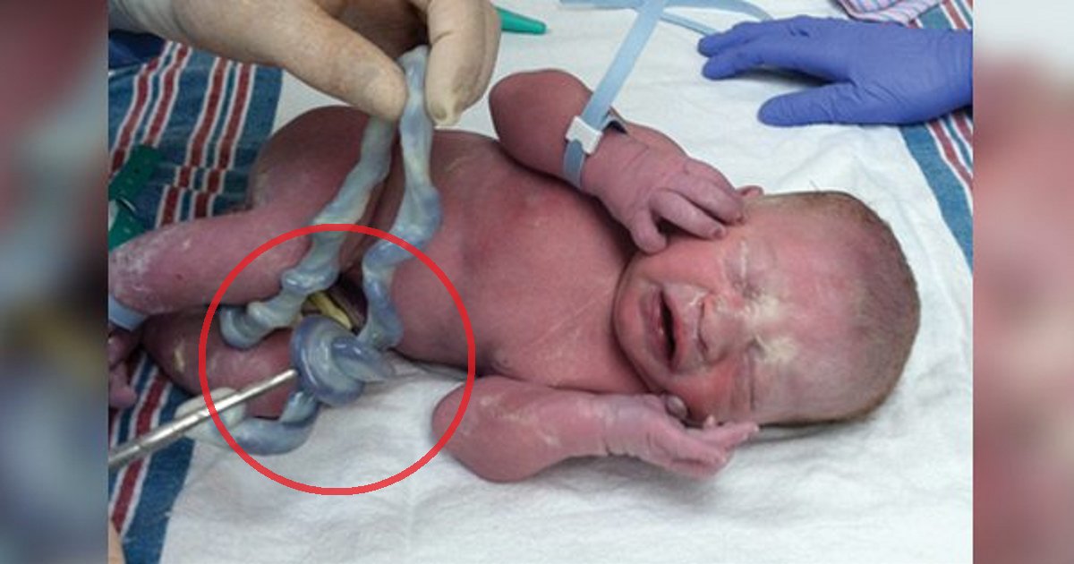 eca09cebaaa9 ec9786ec9d8c 22.png?resize=412,275 - Doctors Thought Baby Passed Away Inside The Womb, He Then Cried In The Delivery Room