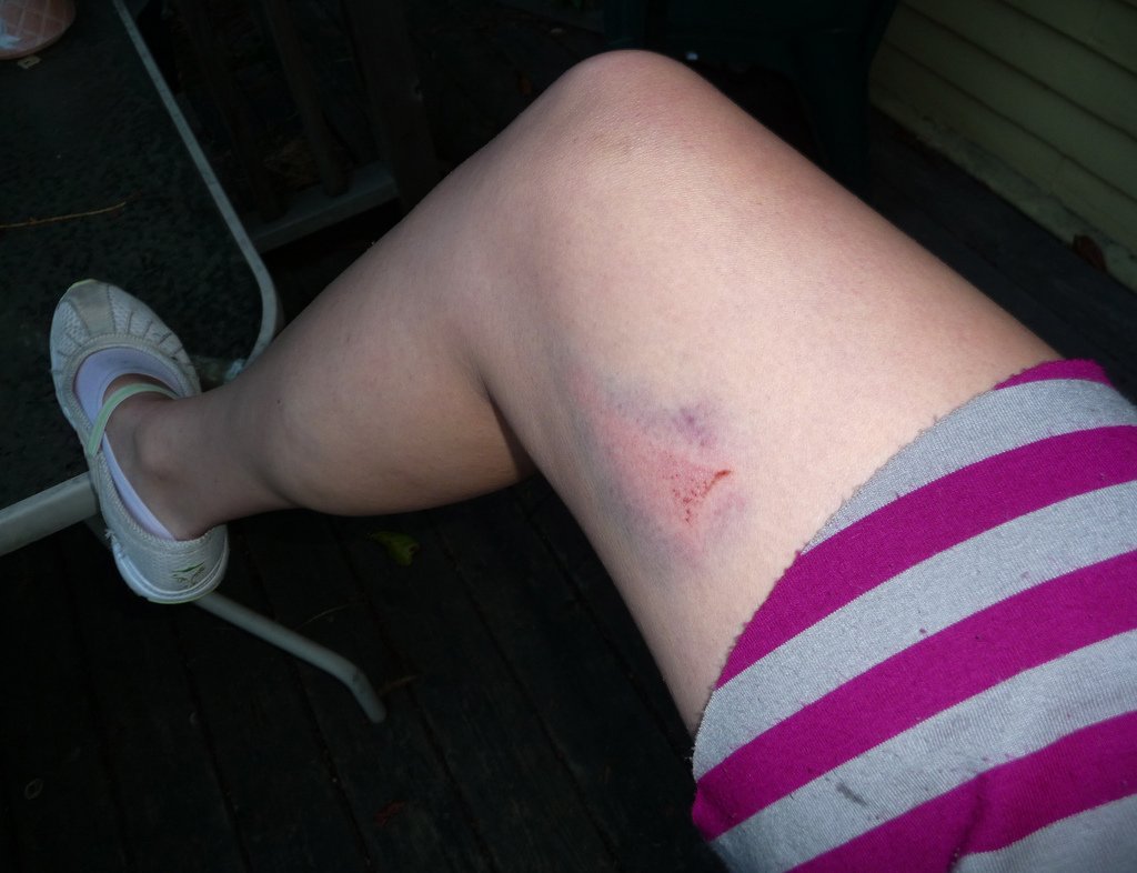 bruise leg에 대한 이미지 검색결과