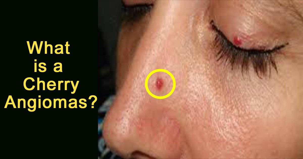 ec8db8eb84ac5 10.jpg?resize=1200,630 - The Red Spots That May Cover Your Body Are Called Cherry Angiomas And Here’s Why We Get Them