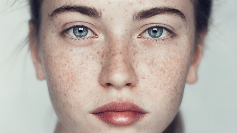 freckles-are-beautiful