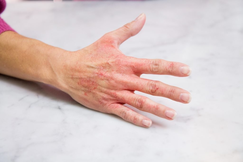 What does a rash on your hands mean