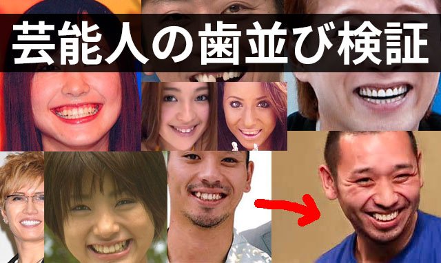 img 5a4cc8208199c.png?resize=300,169 - 良くなった？悪くなった？差し歯の芸能人の評判
