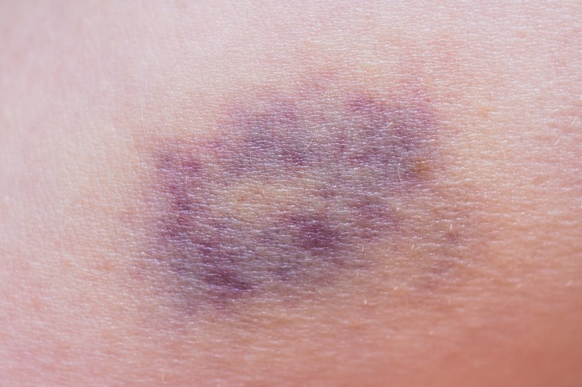 Macro shot of purple bruise on skin.