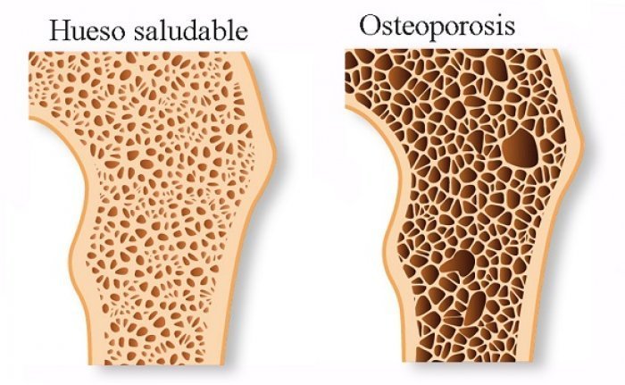 osteoporosis-vs-hueso-saludable