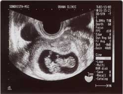 双子　妊娠　3ヶ月에 대한 이미지 검색결과