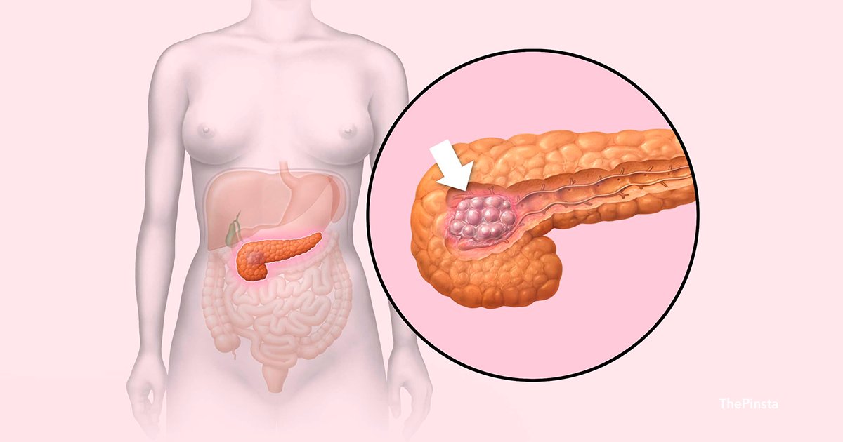 cdcxs.png?resize=412,275 - El cáncer de páncreas puede llegar a ser letal si se detecta tarde, por lo que debemos conocer los síntomas