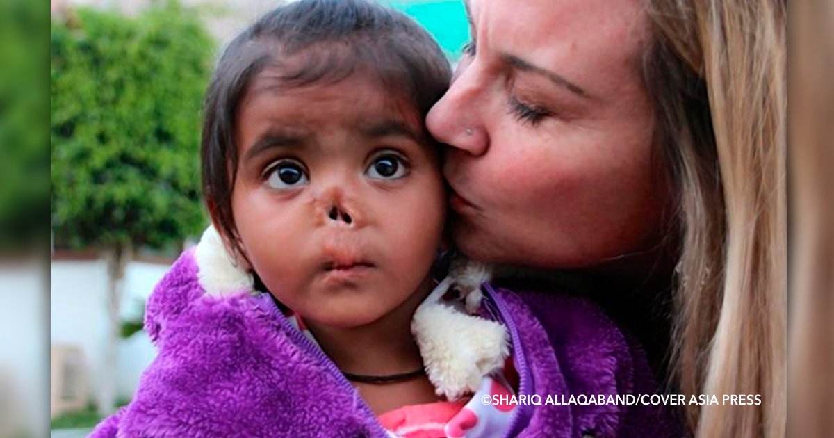 cover322 1.png?resize=1200,630 - Esta mujer adoptó una niña en la India a quien le habían comido la nariz los animales al ser abandonada