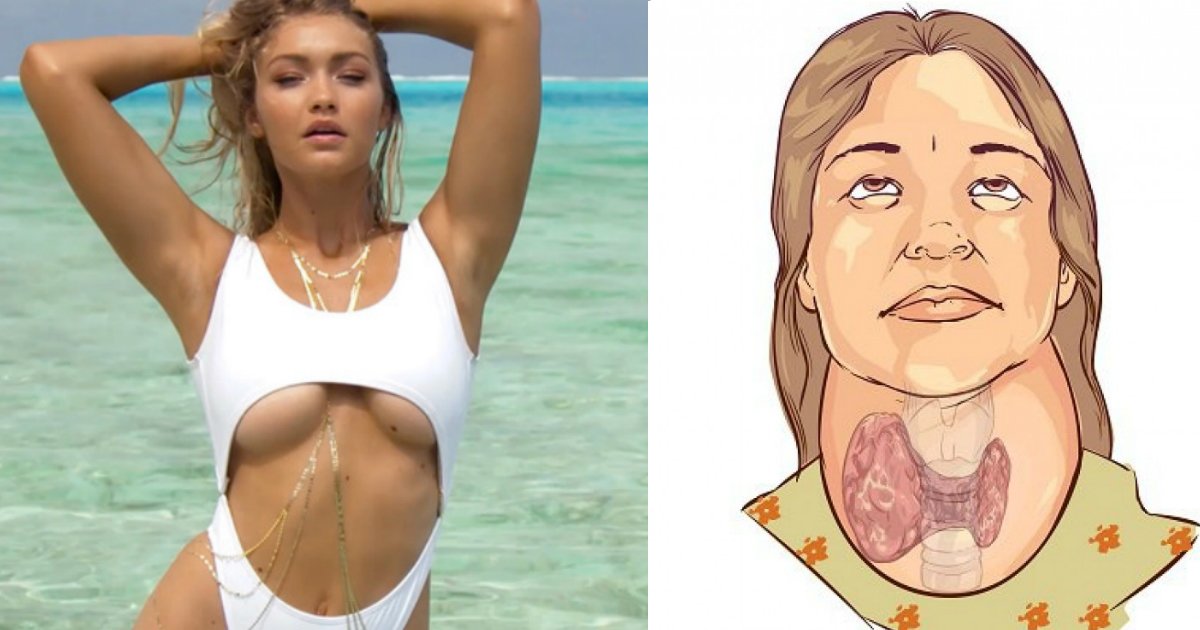 gigi.jpg?resize=412,232 - O que é a síndrome de Hashimoto e o que Gigi Hadid tem a ver com isso?