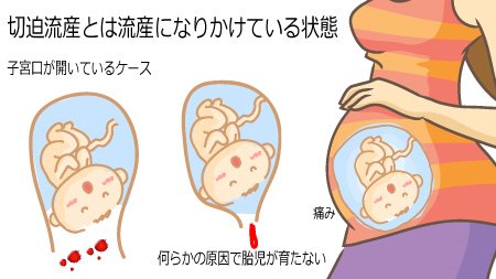 切迫流産에 대한 이미지 검색결과