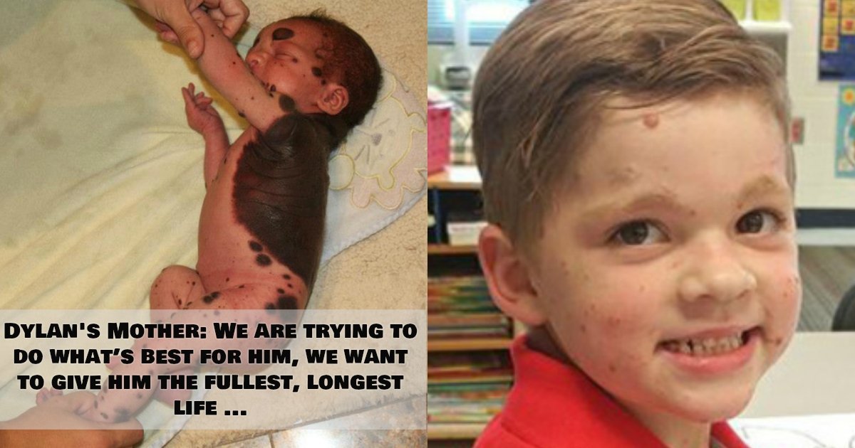1 334.jpg?resize=1200,630 - Boy Born With A Giant Mole Forced To Undergo 26 Surgeries