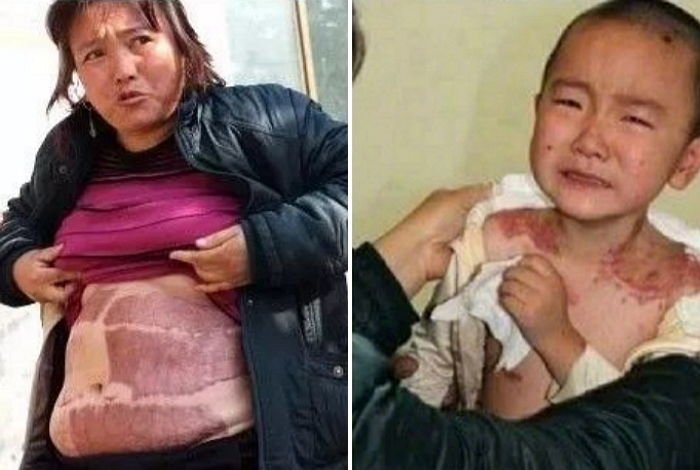 8voj9biguhosvr1pv52s.jpg?resize=412,275 - 病気の娘に「皮膚移植」をするために全身「傷だらけ」になった母親