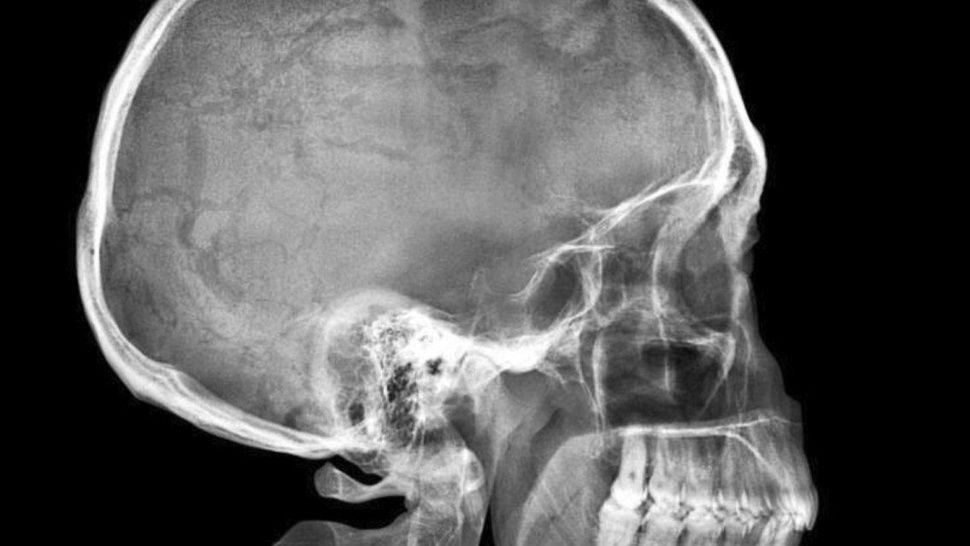 La radiografía de la mujer cuando fue al hospital.
