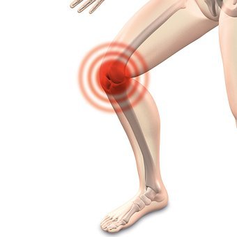Arthrocalman, 관절염, 무릎 Arthrocalman, 관절염, 무릎