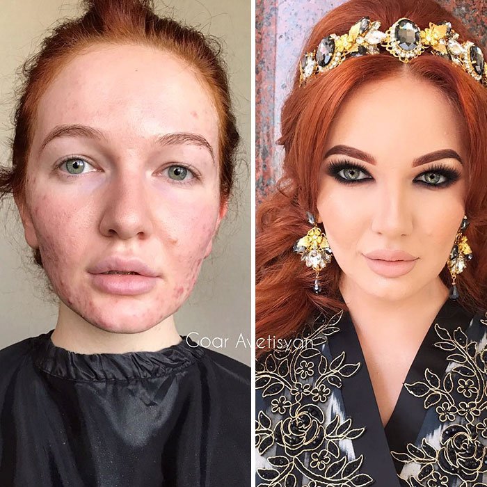 Harem Look On A Model With Acne-Prone Skin