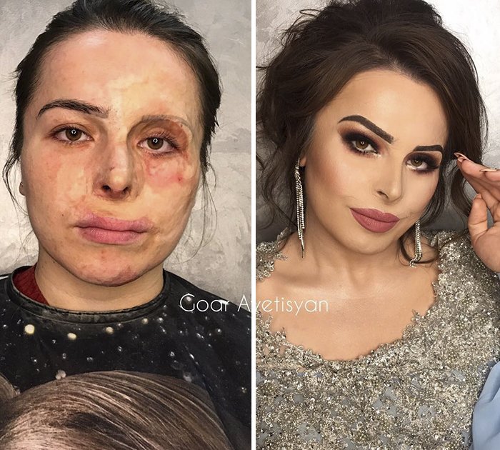 Jamilya From Dagestan Got Severely Burned When She Was Just 2,5 Years Old. Goar Paid For The Tickets From Dagestan So That She Could Have Her Confidence Boosted