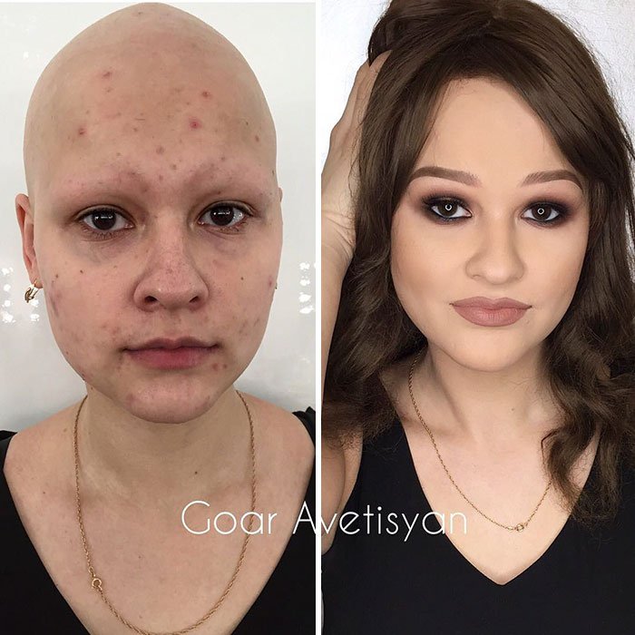 Ann tem alopecia e essa transformação fez com que ela se sentisse mais motivada para lutar contra ela