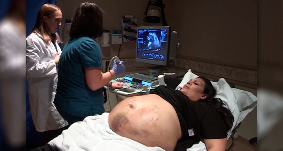 cover 4emb.png?resize=1200,630 - Mujer presenta moretones en todo el vientre durante el embarazo. Al ver el ultrasonido, el médico queda petrificado.
