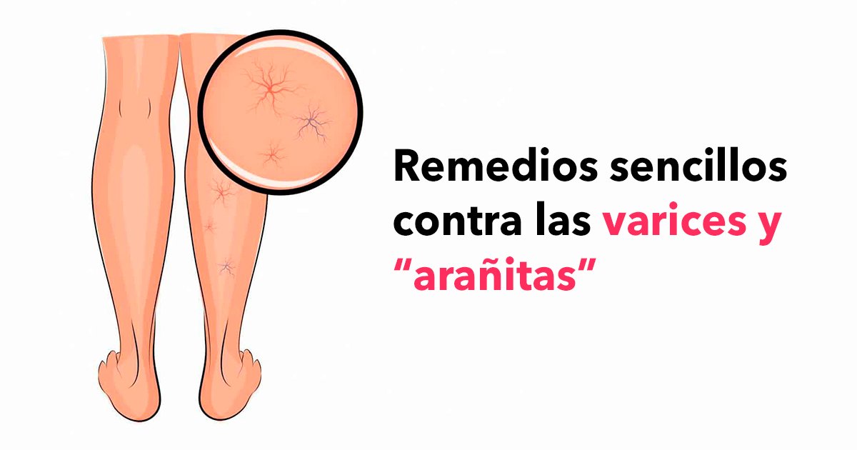 cover22var.jpg?resize=412,275 - Prueba estos remedios sencillos contra las varices y las llamadas “arañitas”