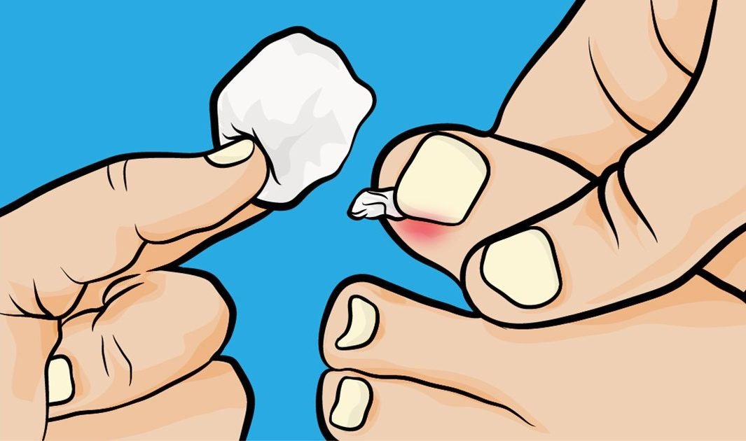 Steps on How to Get Rid of an Ingrown Toenail without Surgery DIY Small Joys