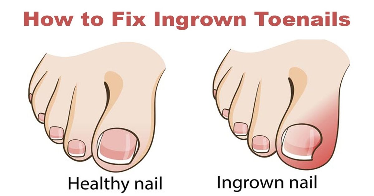 nailthumb2.jpg?resize=412,275 - Natural Ways To Get Rid Of An Ingrown Toenail Without Surgery