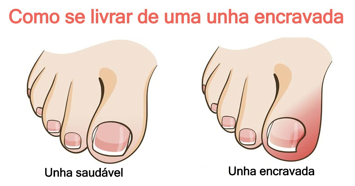 umha.jpg?resize=412,275 - Como se livrar de uma unha encravada sem cirurgia: quatro dicas