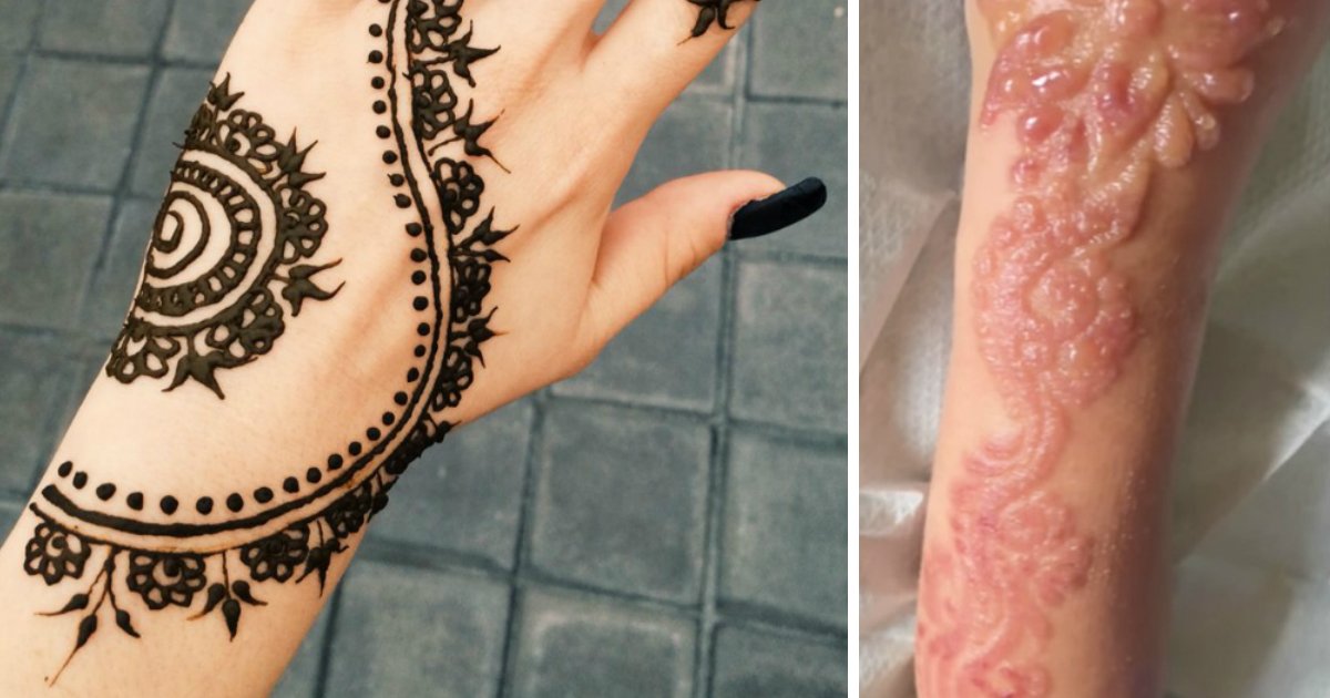 untitled 1 129.jpg?resize=1200,630 - La réaction allergique d'une petite fille au tatouage au henné noir était si grave qu'elle en porte les cicatrices